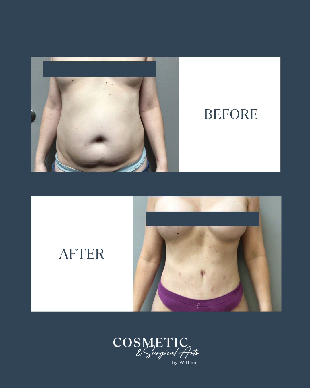 Before and After: 360 Vaser liposuction with full abdominoplasty and silicone breast augmentation