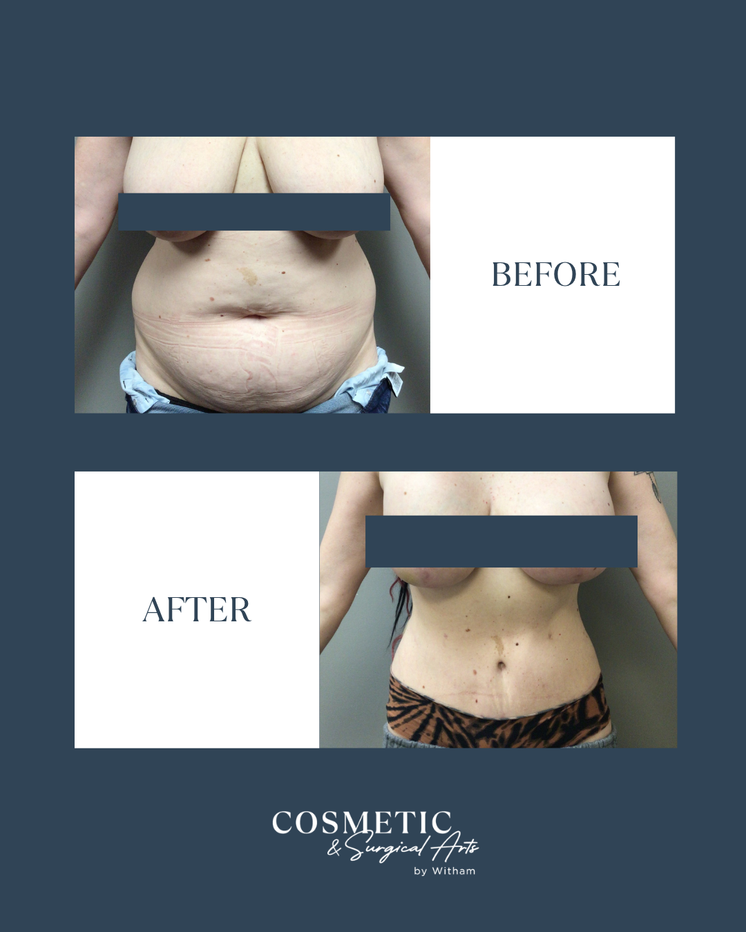360 vaser liposuction with full abdominoplasty with a wise pattern mastopexy with augmentation