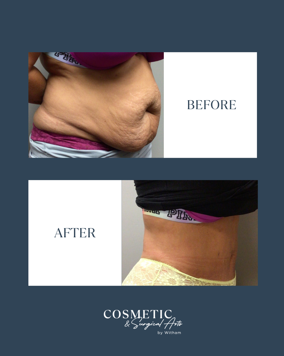 360 Vaser Liposuction with Full abdominoplasty