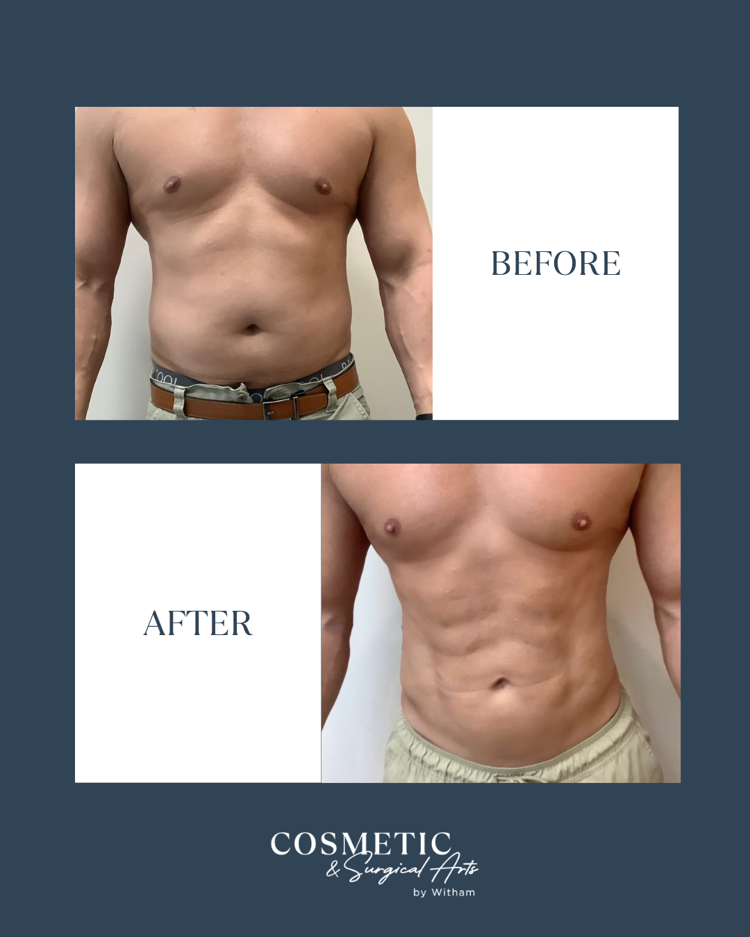 360 Vaser Liposuction helped enhance this patient’s natural contours and reveal a more sculpted midsection