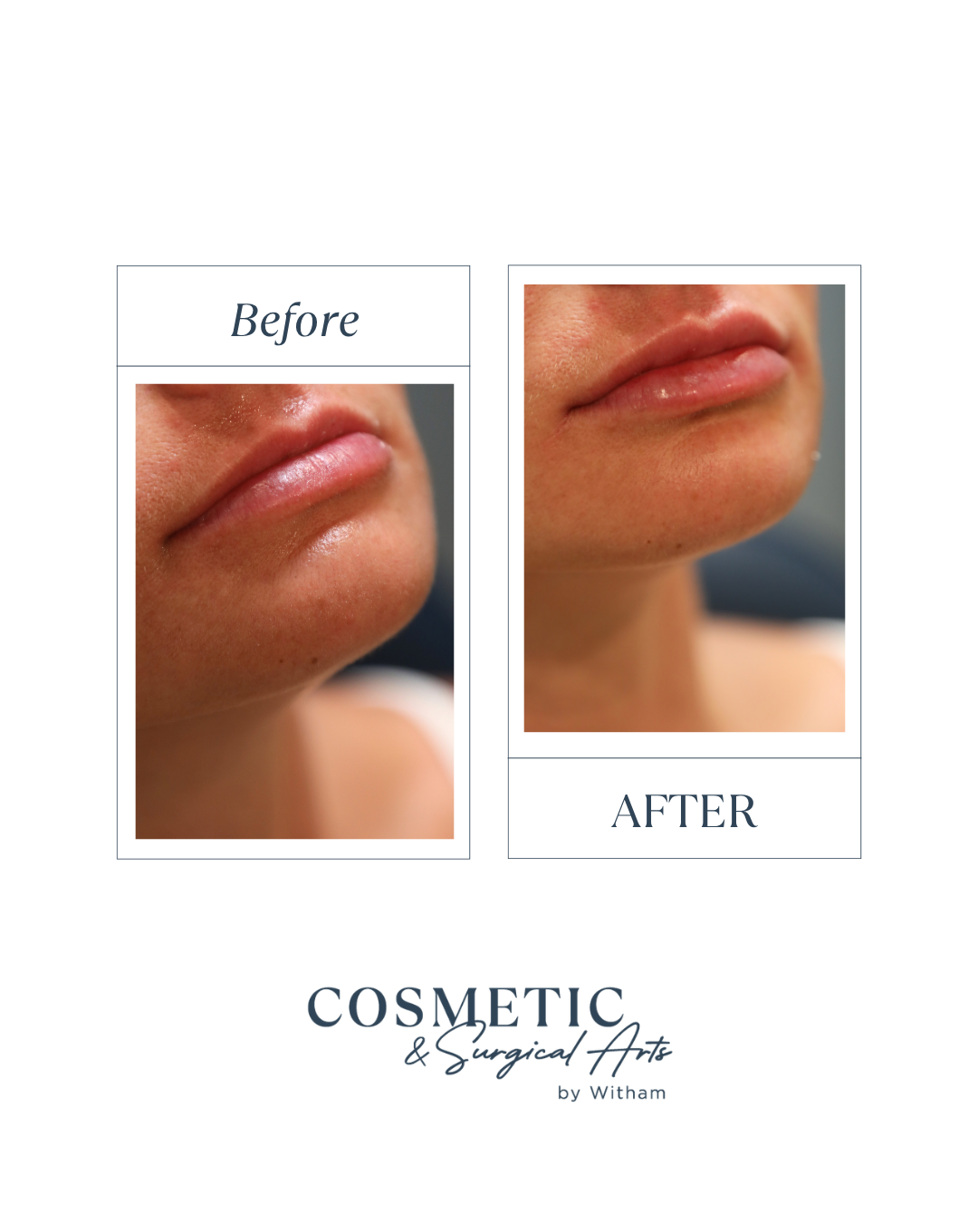 Our patient wanted a naturally fuller upper lip while keeping her results soft and balanced. 