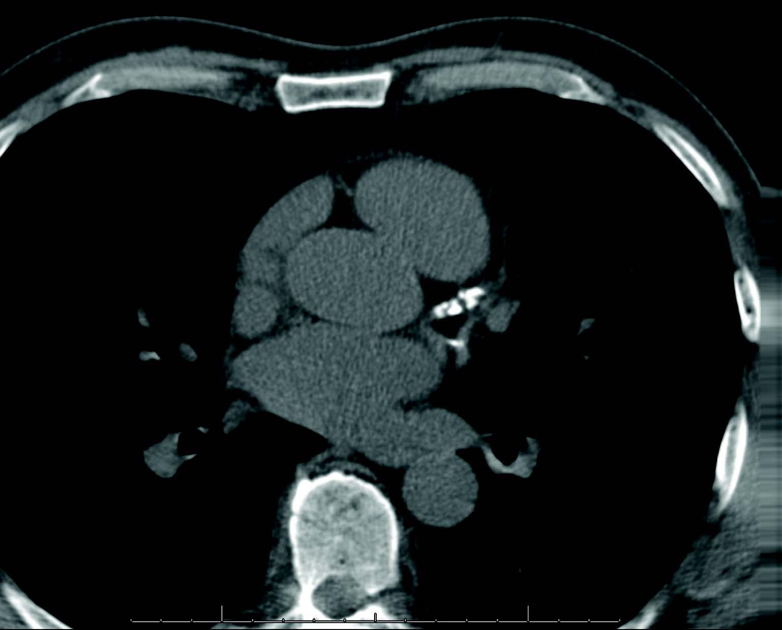 Heart Score CT Scan Image